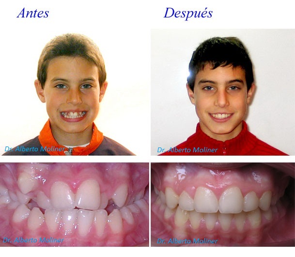 mejor ortodoncia niños zaragoza
