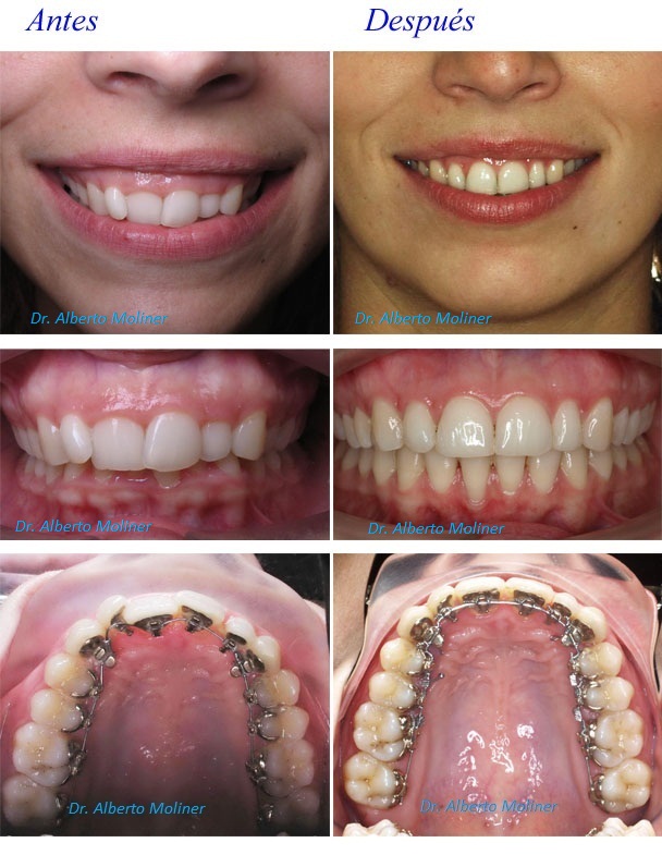 brackets invisibles zaragoza brackets invisibles zaragoza