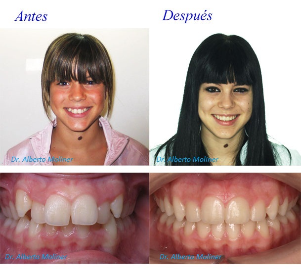 tratamiento ortodoncia niños zaragoza