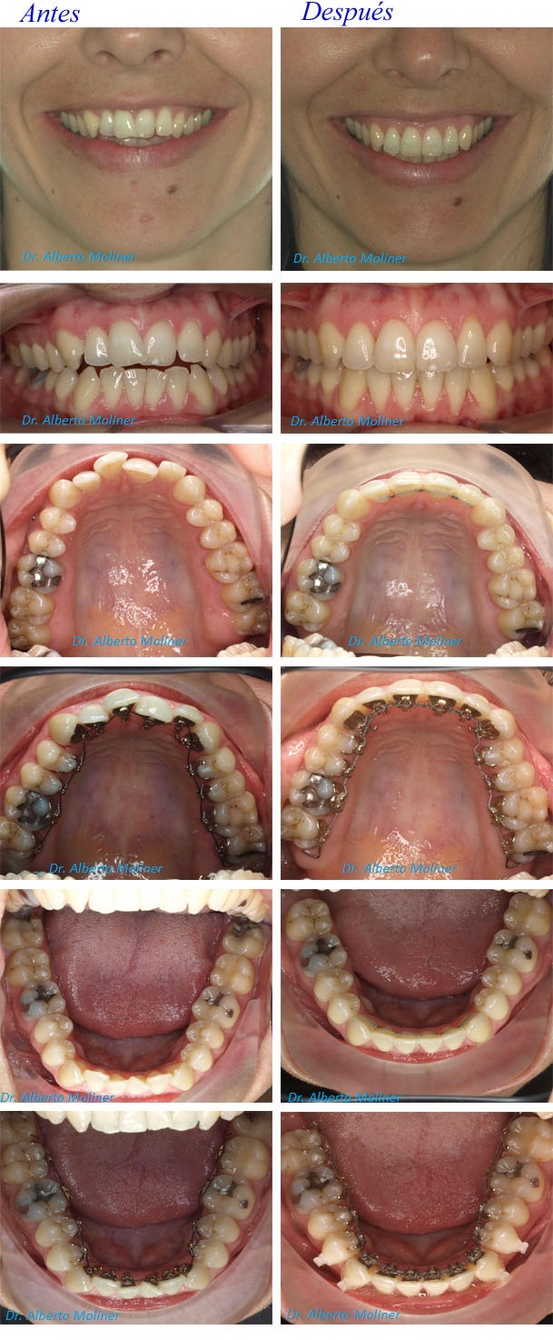Clinica ortodoncia invisible zaragoza