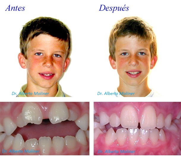 ortodoncia infantil zaragoza