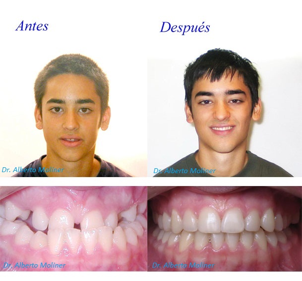 brackets zaragoza