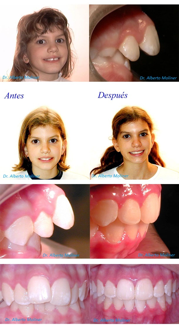 brackets niños zaragoza brackets niños zaragoza