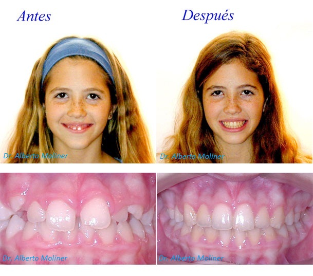 ortodoncia sonrisa gingival niños