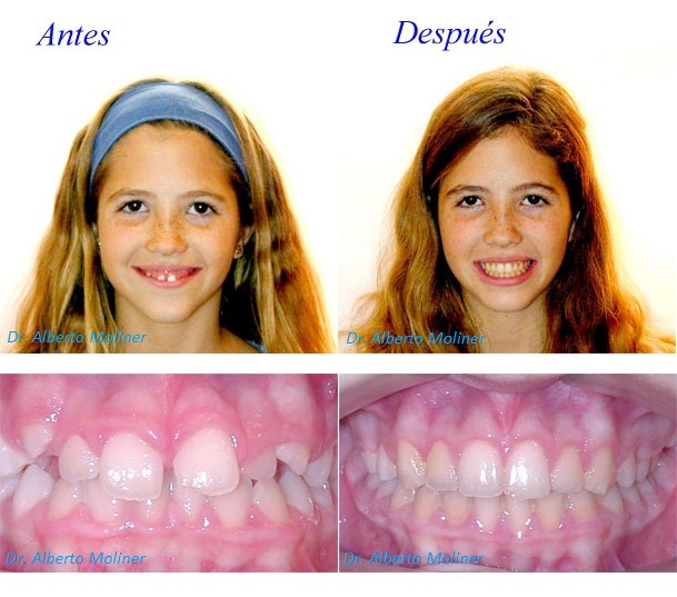ortodoncia sonrisa gingival niños ortodoncia sonrisa gingival niños