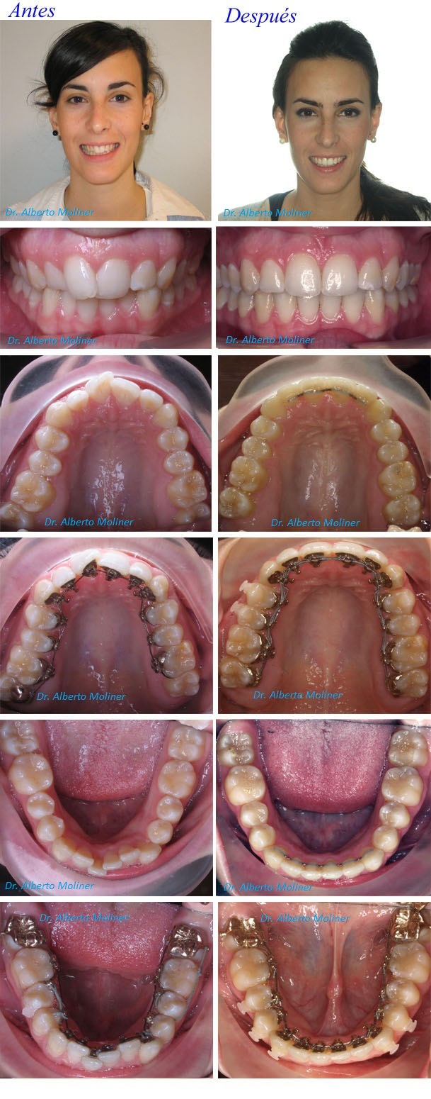 ortodoncia adolescentes zaragoza