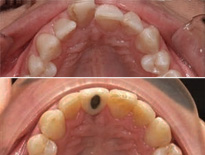 ortodoncia adultos zaragoza moliner 05