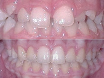 ortodoncia infantil zaragoza moliner 02