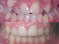 ortodoncia infantil zaragoza moliner 03