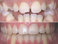 ortodoncia infantil zaragoza moliner 04