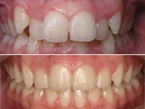 ortodoncia infantil zaragoza moliner 05