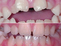 ortodoncia infantil zaragoza moliner 07