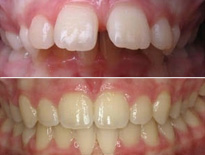 ortodoncia infantil zaragoza moliner 0893
