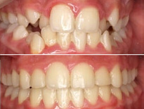 ortodoncia infantil zaragoza moliner 09
