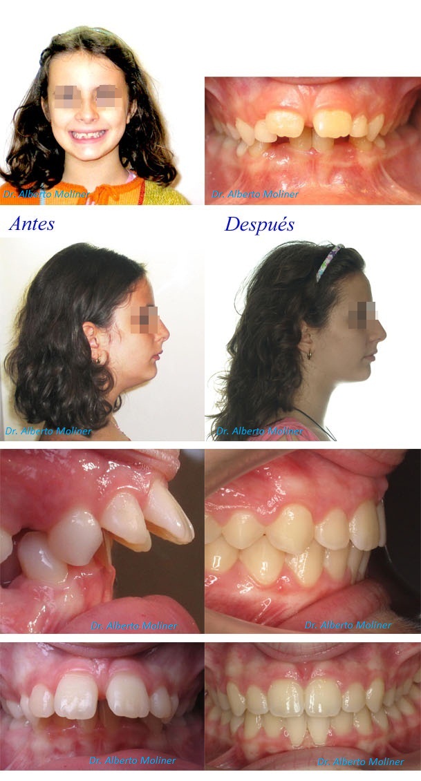 Caso de ortodoncia para niños resuelto en Ortodoncia Moliner Zaragoza