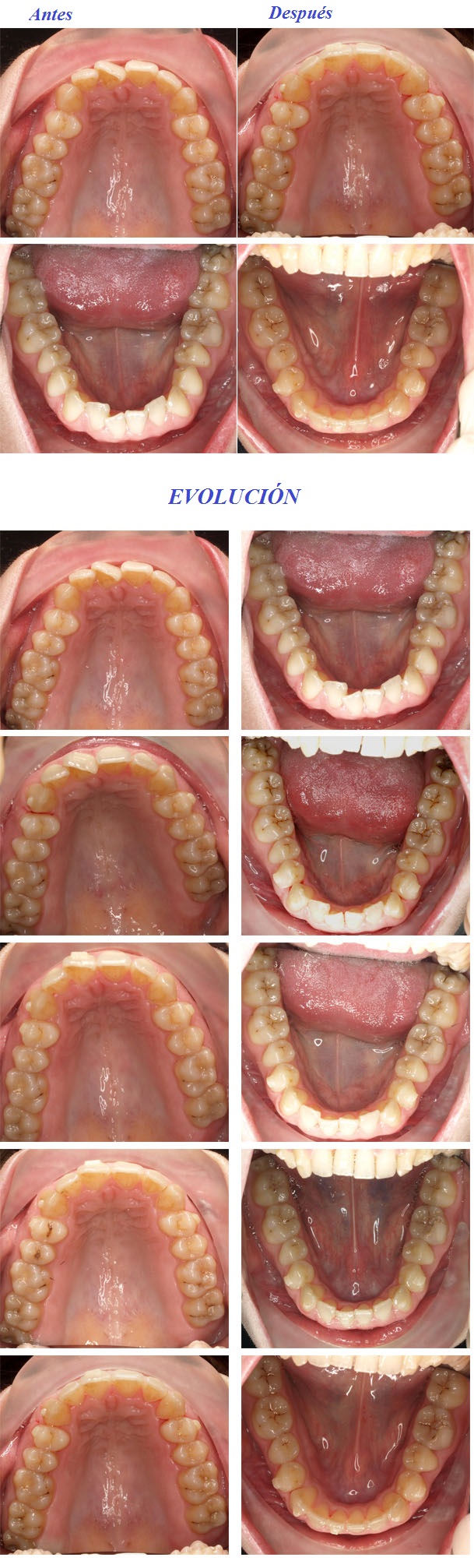 ortodoncista invisalign Zaragoza