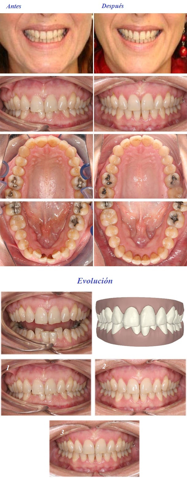 tratamiento invisalign zaragoza