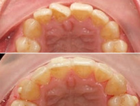 invisalign ortodoncia zaragoza moliner 01