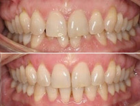 invisalign ortodoncia zaragoza moliner 02