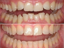 invisalign ortodoncia zaragoza moliner 03