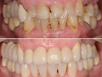 invisalign ortodoncia zaragoza moliner 04