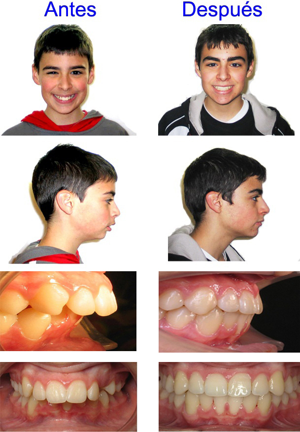 ortodoncia adolescentes zaragoza