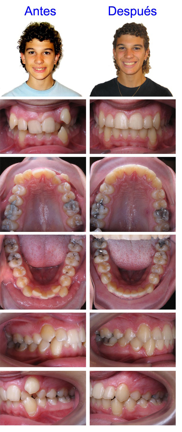 brackets invisibles zaragoza brackets invisibles zaragoza