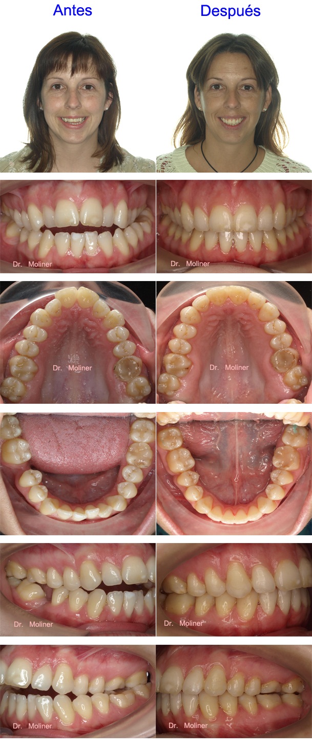 clinica brackets zaragoza