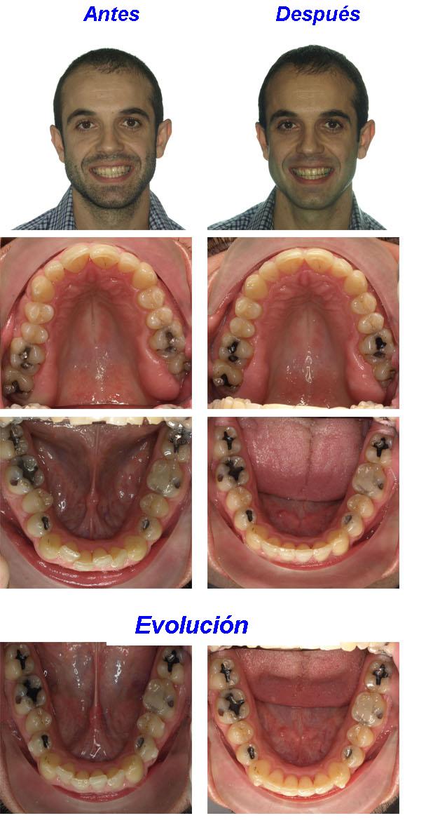 ortodoncia invisalign zaragoza