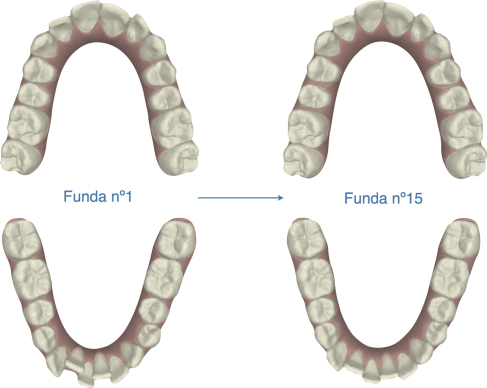 Mi diario Invisalign: capítulo 12