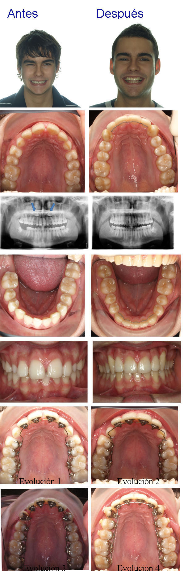 ortodoncia diastema zaragoza