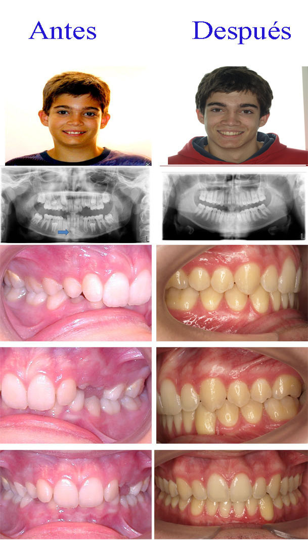 ortodoncia adolescentes zaragoza