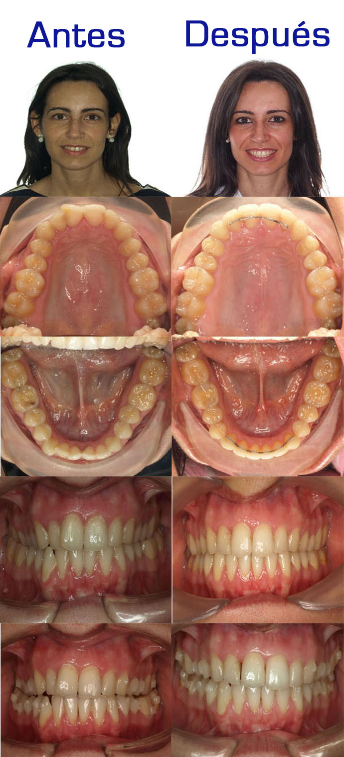 invisalign zaragoza invisalign zaragoza