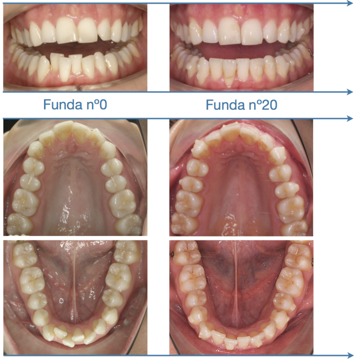 Mi diario Invisalign: capítulo 13