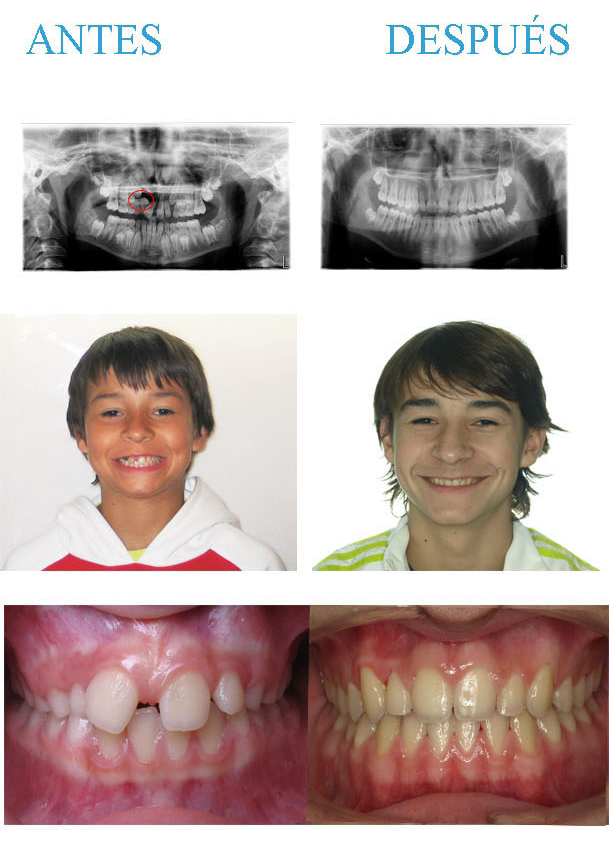 ortodoncia niños zaragoza