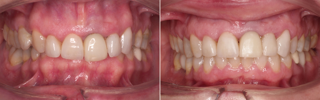 tratamiento brackets adulto Tratamiento brackets adulto