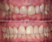 Tratamiento brackets adulto