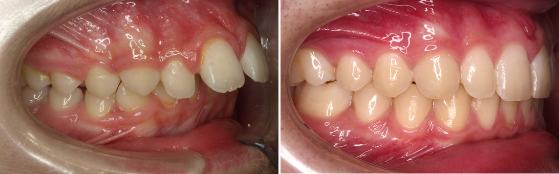 caso espacio dientes 22 07 Tratamiento brackets adulto