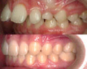 ortodoncia invislign 22 07 min