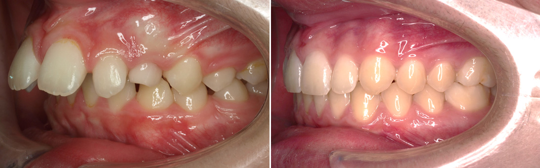 ortodoncia invislign 22 07 invisalign zaragoza