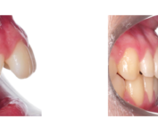 aparatologia de avance mandibular