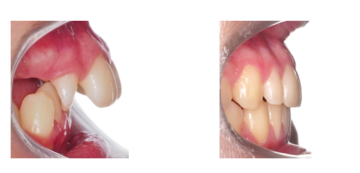 aparatologia de avance mandibular