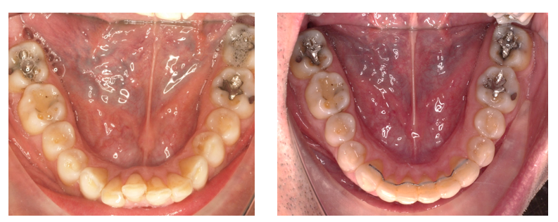 ortodoncia mordida cruzada