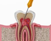 endodoncia