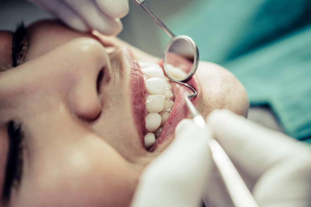 Troneras dentales: qué son, causas y cómo eliminarlas