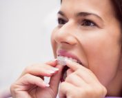 Qué son los ataches en Invisalign y para qué sirven