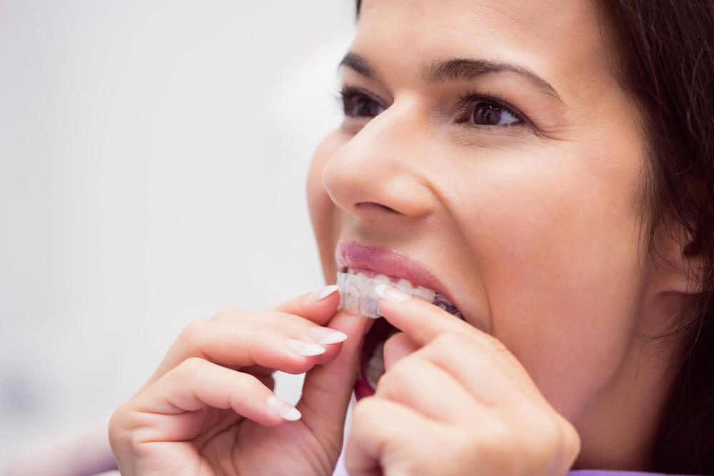 Qué son los ataches en Invisalign y para qué sirven
