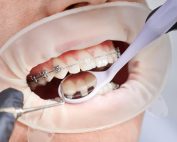 ¿Los brackets duelen? 7 consejos para evitar molestias