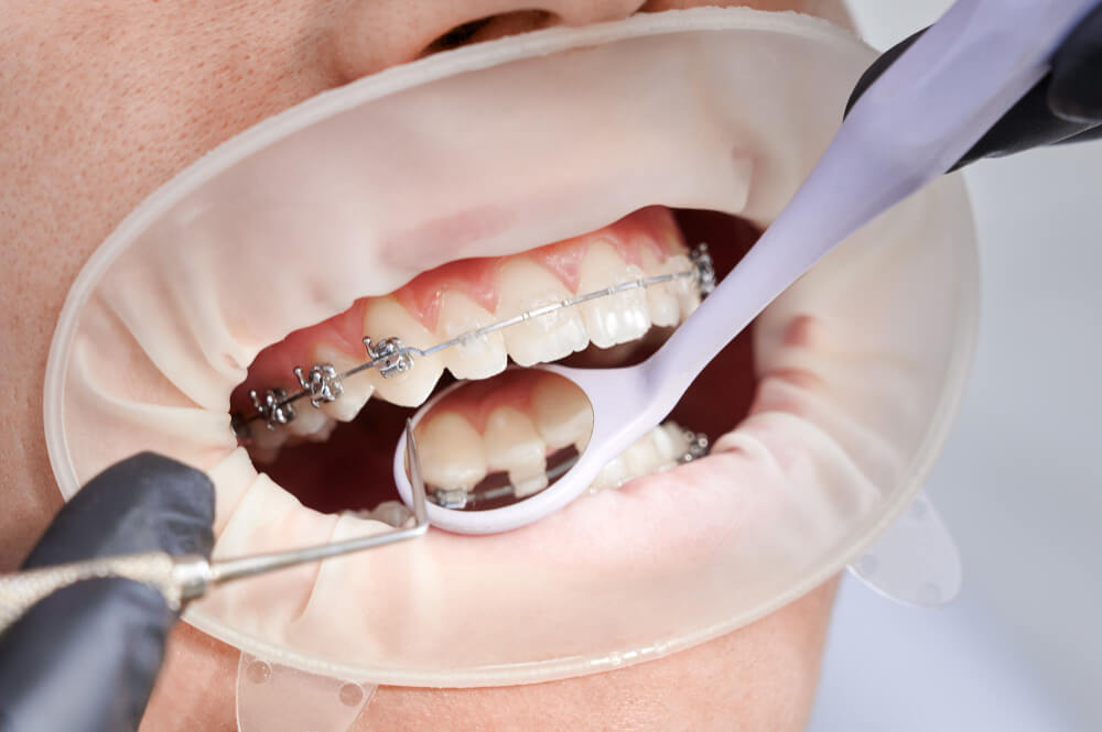 ¿Los brackets duelen? 7 consejos para evitar molestias