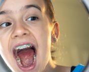 Maloclusiones dentales: qué son, causas y tratamientos